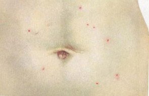 Высыпания при тифе Высыпания при тифе