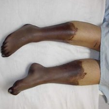 Анаэробная инфекция Анаэробная инфекция