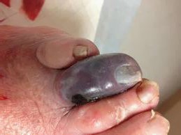 Гангрена Гангрена