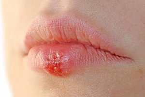 Герпес на губе Герпес на губе