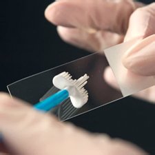 Мазок на анализе Мазок на инфекцию