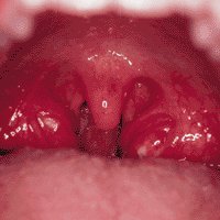 Острый тонзиллит Острый тонзиллит