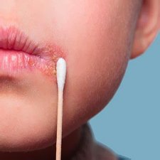 Простуда на лице Простуда на лице