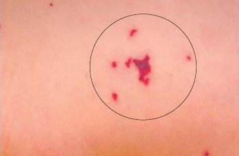 Сыпь при менингококковой инфекции Сыпь при менингококковой инфекции