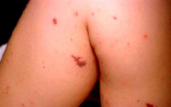 Сыпь на ноге Сыпь на ноге