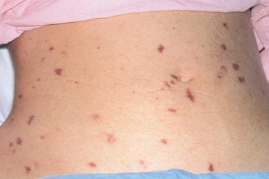 Сыпь на животе Сыпь на животе