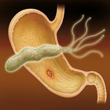 Инфекция и желудок Инфекция и желудок